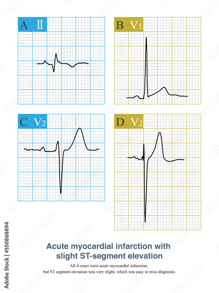 In AMI, if the amplitude of ST segment elevation is less than 1mm, it ...