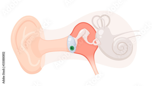 鼓膜チューブを挿入したイラスト_中耳炎