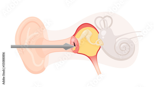 急性中耳炎の鼓膜切開のイラスト photo