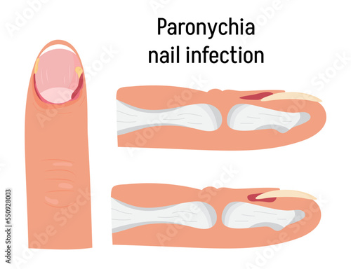 Paronychia concepnt vector for medical blog, app, banner. Nail inflammation that may result from trauma, irritation or infection.