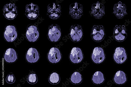 MRI Brain Axial views .to evaluate brain tumor. Glioblastoma, brain metastasis isodensity mass with an ill-defined margin and surrounding edema at the right frontal lobe. photo