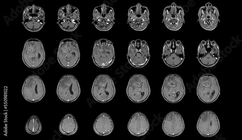 MRI Brain Axial views .to evaluate brain tumor. Glioblastoma, brain metastasis isodensity mass with an ill-defined margin and surrounding edema at the right frontal lobe.