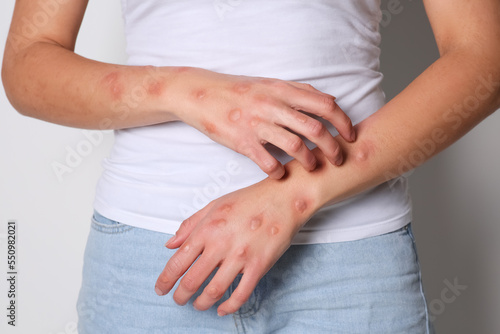 Woman with rash suffering from monkeypox virus on white background  closeup