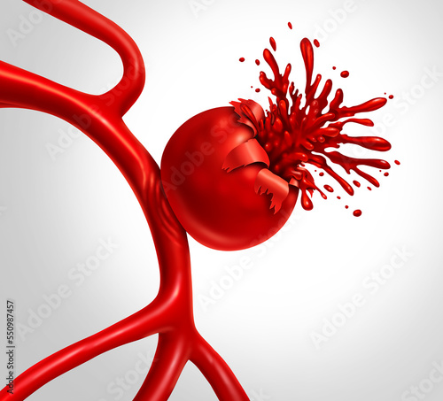 Ruptured Aneurysm as a medical concept with a bulging blood vessel as a ballooning artery with a rupture bleeding blood and causing a risk of hemorrhagic stroke photo