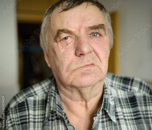Aged man with facial nerve paralysis, Bell's palsy.