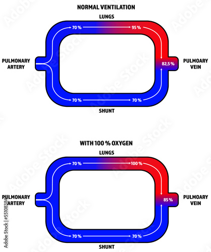 A diagram of how a pulmonary shunt works