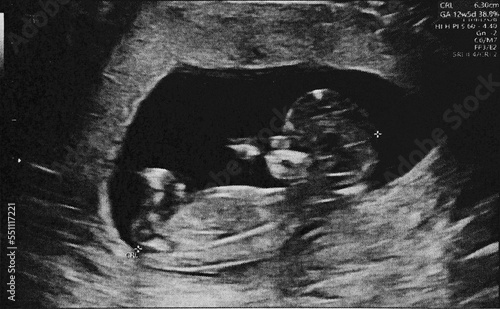 Fotografiet Pregnant baby infant ultrasound display