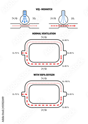 VQ Mismatch - Ventilation Perfusion Mismatch and Ratio