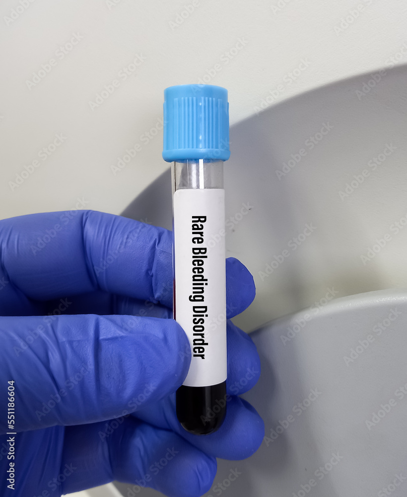 Blood sample for Rare Bleeding Disorders(RBDs) test, factor XI test