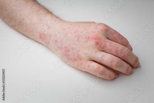 Allergy, red itchy rash on male hand on white table. Dermatological problem, skin symptom of patient. Close up shot
