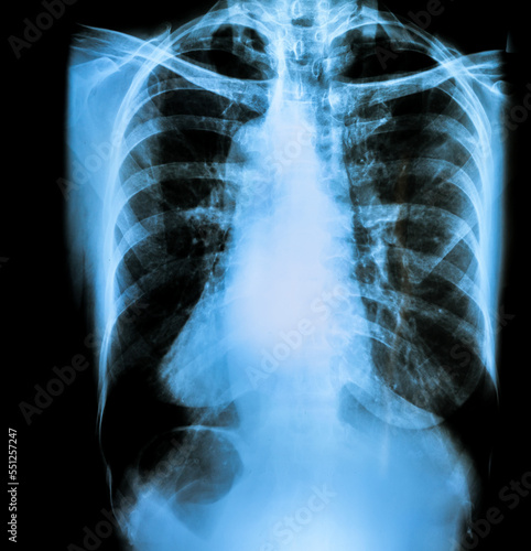 x ray image of chest