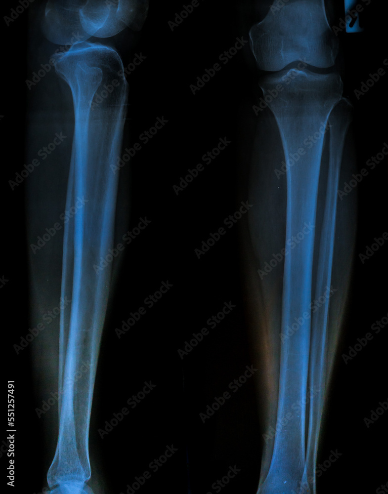 x ray of knee x ray of knee