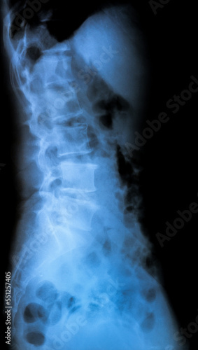 X-Ray spine of patient