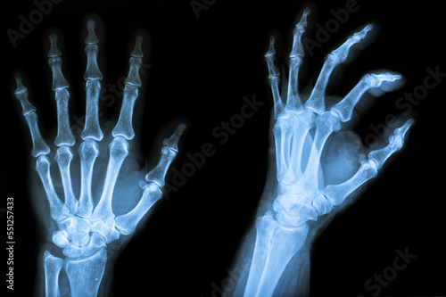 X-ray human hand. X-ray of hand bones