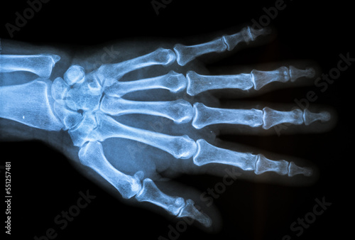x ray of a human hand