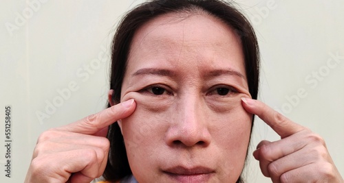 portrait the fingers holding the flabbiness adipose sagging, ptosis and flabby skin beside the eyelid, cellulite and bag under the eyes, dark spots and blemish on the face of woman's. 