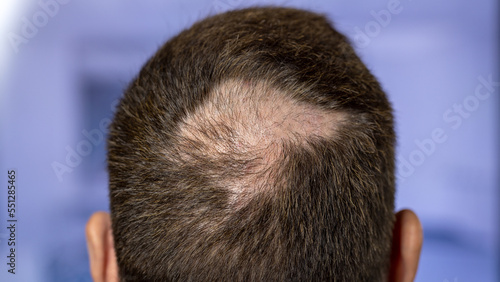 Man with hair loss problems closeup, isolated. Alopecia balding hairs on man scalp. Human alopecia or hair loss - person hand pointing his bald head. Scratching his head. Baldness. Depression, stress