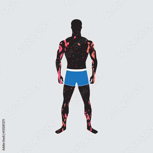 Painful dermatous rash on male body with dark skin