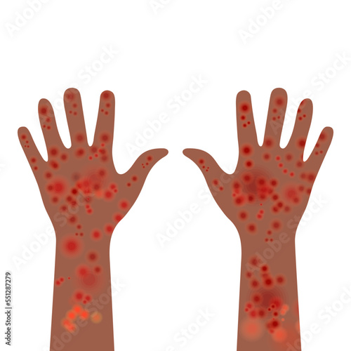 Painful rash on both arms with brown skin tone