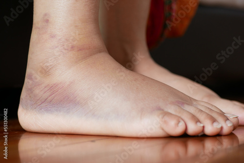 close up of women feet with swelling 