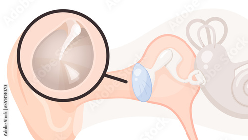 耳の構造と鼓膜のイラスト_正常な鼓膜