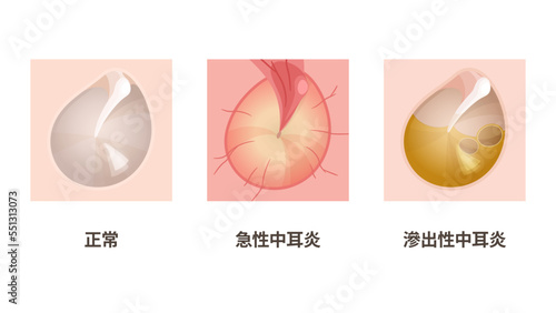 中耳炎の鼓膜のイラスト_正常_急性中耳炎_滲出性中耳炎