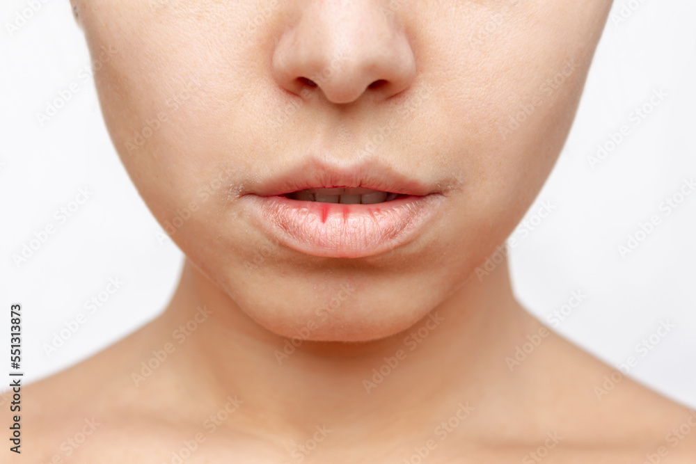 Cropped shot of a young caucasian woman with dry cracked lips from frost or vitamin deficiency isolated on a white background. Flaky, weathered lips - obrazy, fototapety, plakaty 