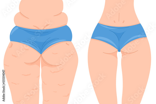 Color vector illustration before and after losing weight. Female back view with and without cellulite. Female buttocks in a blue panties