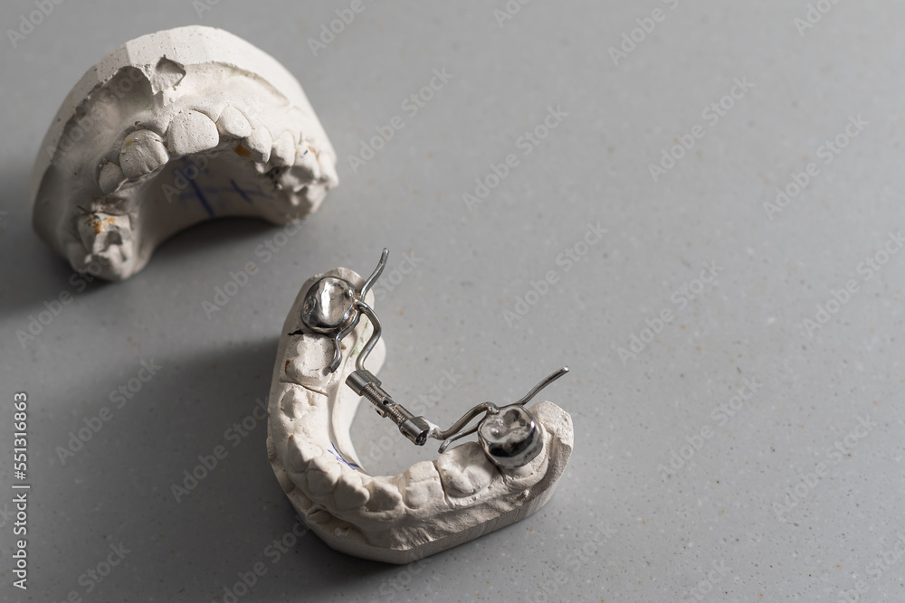 Plaster models of dental prostheses. Demonstration models of dentures ...