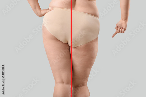 Young woman before and after anti cellulite treatment on light background, top view