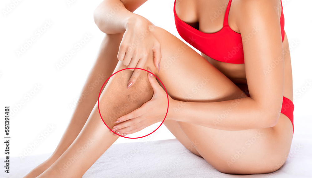 Fototapeta premium Beautiful slender woman sits on a couch in a spa salon. She shows varicose veins in the lower legs.Treatment of varicose veins and capillaries.