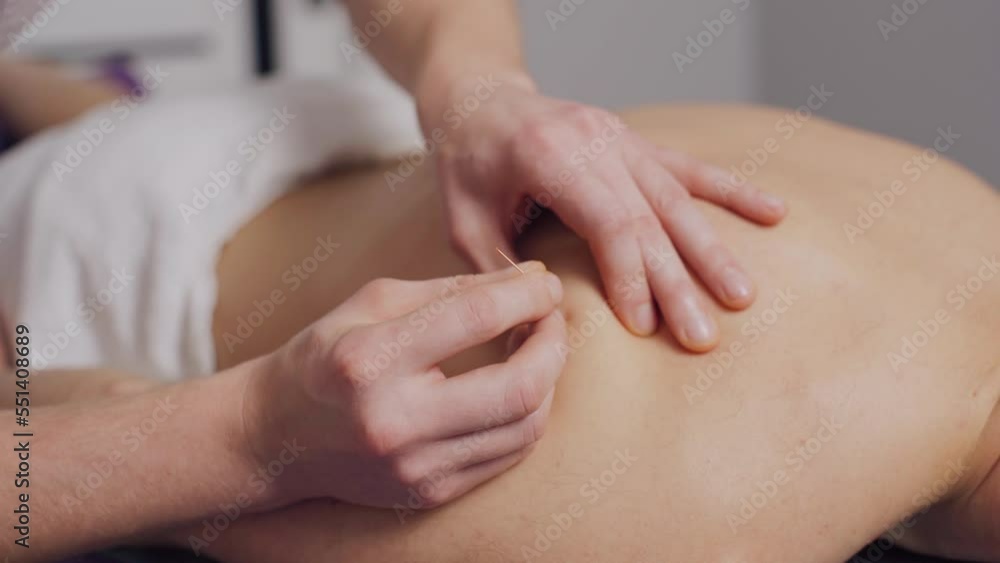 The doctor makes acupuncture on the patient's back. Acupuncture treatment. The doctor makes acupuncture on the patient's back. Acupuncture treatment.