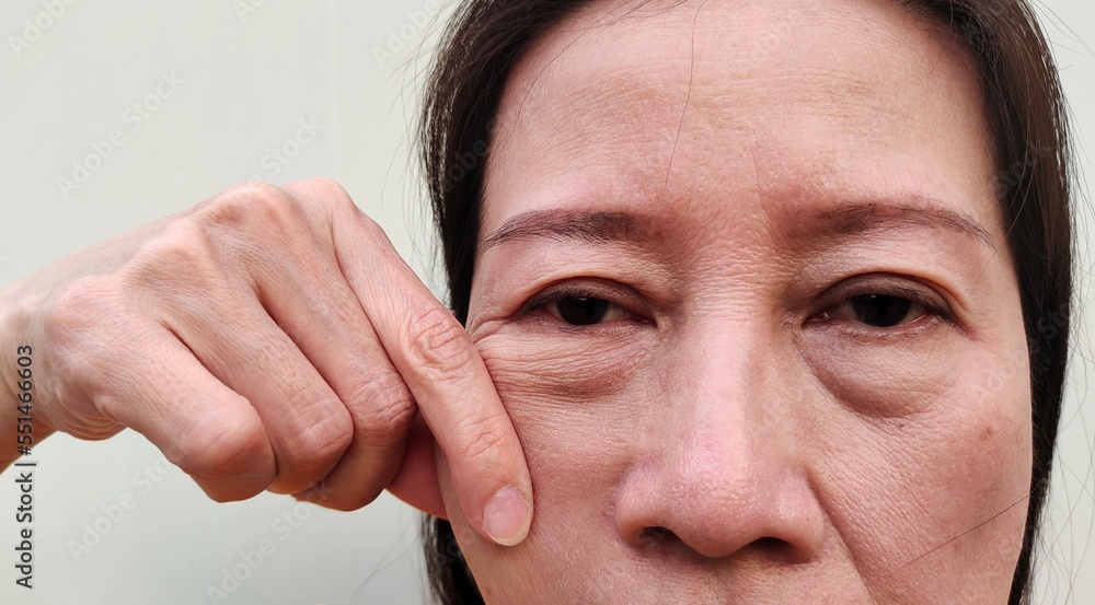 portrait the fingers squeezing the flabbiness and wrinkle beside the cheek, ptosis and flabby skin beside the eyelid, cellulite and bag under the eyes, health care and beauty concept. portrait the fingers squeezing the flabbiness and wrinkle beside the cheek, ptosis and flabby skin beside the eyelid, cellulite and bag under the eyes, health care and beauty concept.