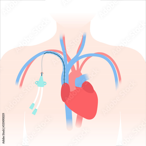 Tunneled central venous catheter placed in the subclavian vein. Patient with CVC long term access device for chemotherapy infusions and blood sampling. Central line tube close up. Vector illustration.