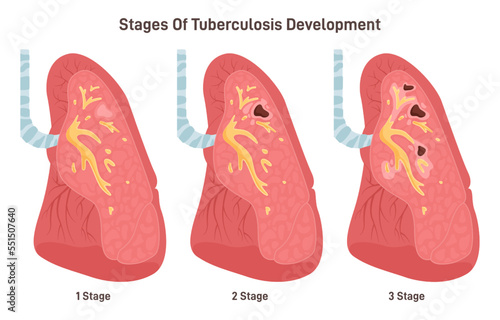Stages of tuberculosis development. Respiratory system disease. Human lung