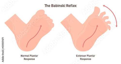 Babinski reflex. Stimulation of the lateral plantar aspect of the foot leads photo