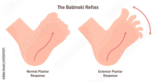 Babinski reflex. Stimulation of the lateral plantar aspect of the foot leads