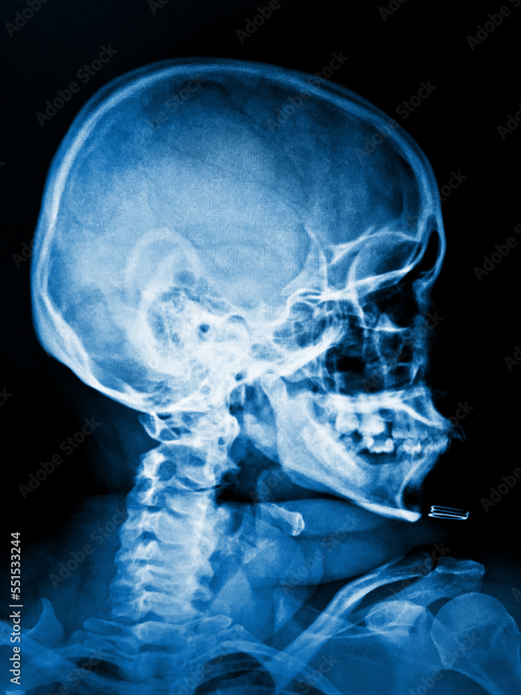 x ray image of human skull Stock Photo | Adobe Stock