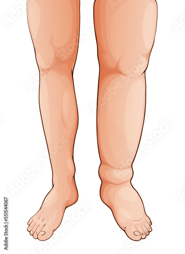 Edema swollen leg and foot. Lymphedema. Oedema disease symptom, fluid retention in legs, lymph circulatory problem and body tissue inflammation or thrombosis syndrome medical vector illustration