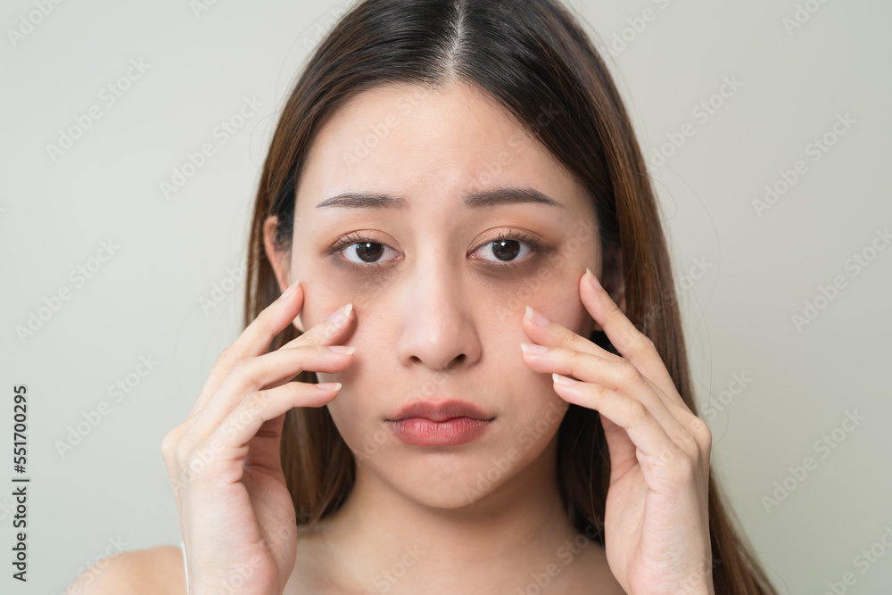 lack of sleep problem, Worried Asian young woman pointing finger at dark circles under her eyes lack of sleep problem, Worried Asian young woman pointing finger at dark circles under her eyes