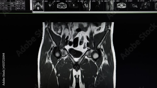 Hip MRI scan showing left side pyomyositis and intramuscular abscess at left iliacus and gluteus muscles. photo