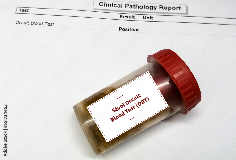 Foto de Stool sample container for occult blood test (OBT) with