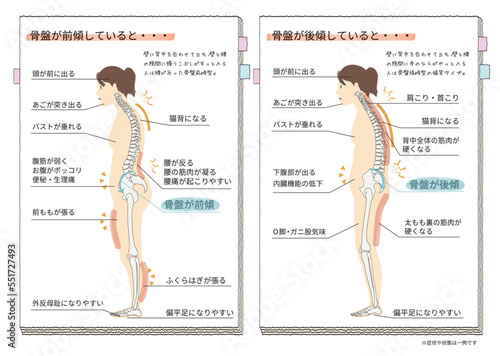 骨盤が後傾・前傾したときの体の状態と症状を表した横向き人物イラスト
