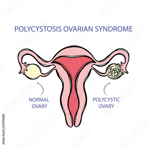 POLYCYSTOSIS OVARIAN SYNDROME Female Reproductive System Cells Similar To Lining Of Uterus Grow Outside For Medical Education Diagram Human Anatomy Vector photo