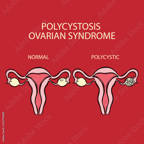 POLYCYSTIC OVARIAN SYNDROME VS NORMAL Female Reproductive System Cells Similar To Lining Of Uterus Grow Outside For Medical Education Diagram Human Anatomy