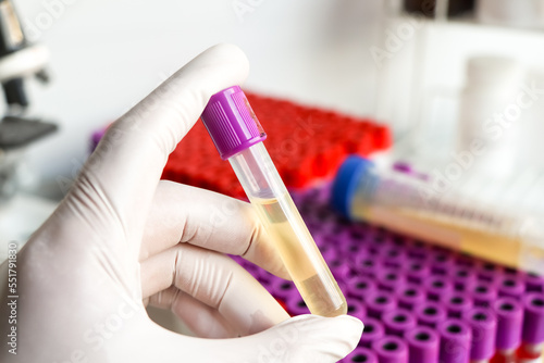 Urine test to look for abnormalities from Urine   Urine sample to analyze in the laboratory