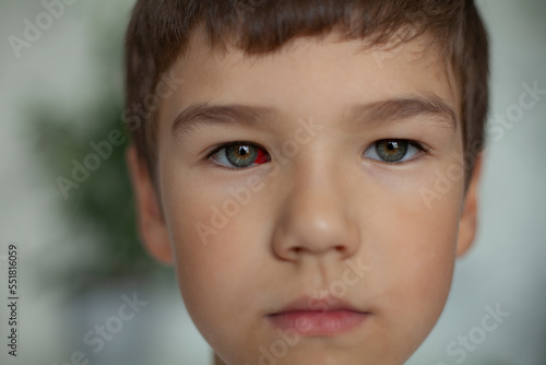 close-up of the boy's face with a red spot on the eyeball photo