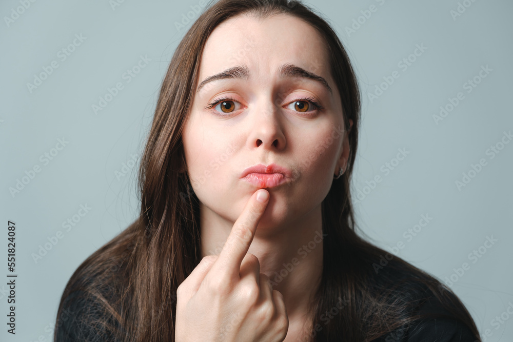 Virus herpes on lips close-up. Unhappy woman shows on a painful swollen lips. Portrait of young beautiful girl of European appearance with infection injury. Dermatology sickness. Facing treatment Virus herpes on lips close-up. Unhappy woman shows on a painful swollen lips. Portrait of young beautiful girl of European appearance with infection injury. Dermatology sickness. Facing treatment