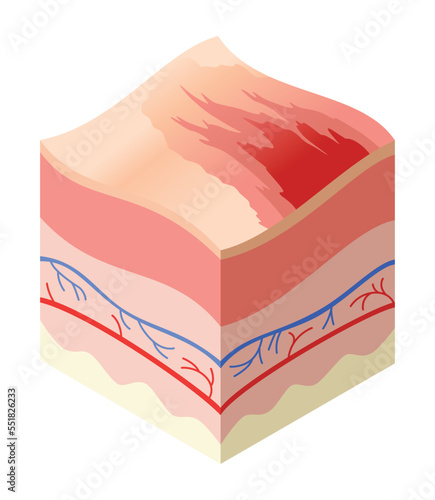 Skincare medical concept. Problems in cross-section of human skin horizontal layers structure. Anatomy illustrative model unhealthly layer of skin
