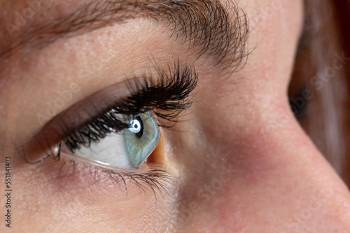 Female eye affected by keratoconus, or conical cornea photo